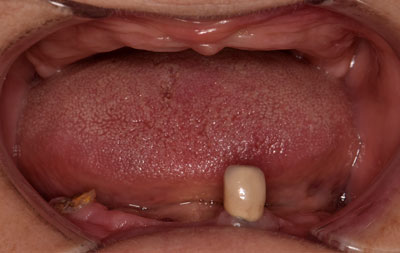 Фото состояния зубов до комплексной имплантации зубов