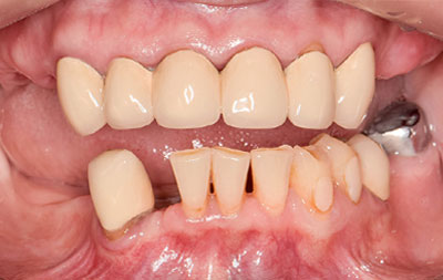 Фото зубов до имплантации