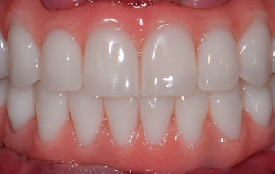 Фото зубов после установки протезов