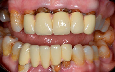 Фото до проведения имплантации всех зубов за 3 дня