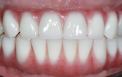 Фото после перепротезирования зубов через один год